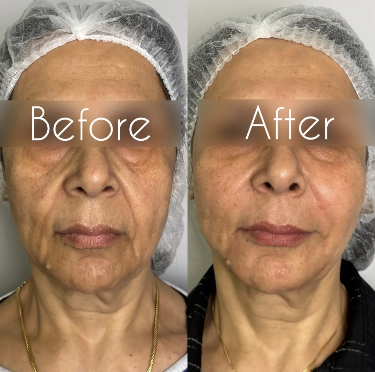 before and after rf virtue