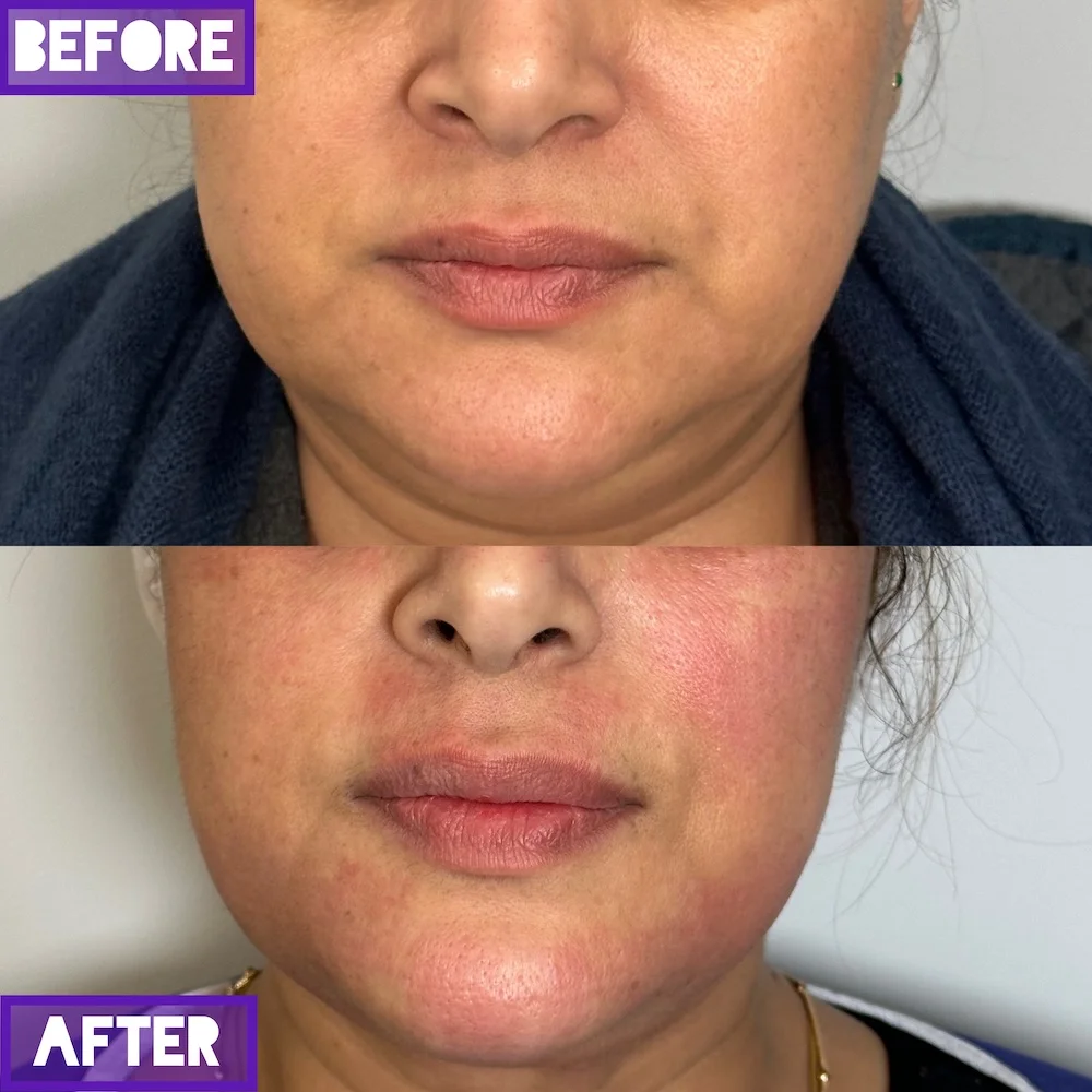 لیفت با ار اف فرکشنال در ساری