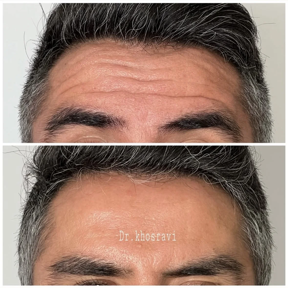 بوتاکس پیشانی