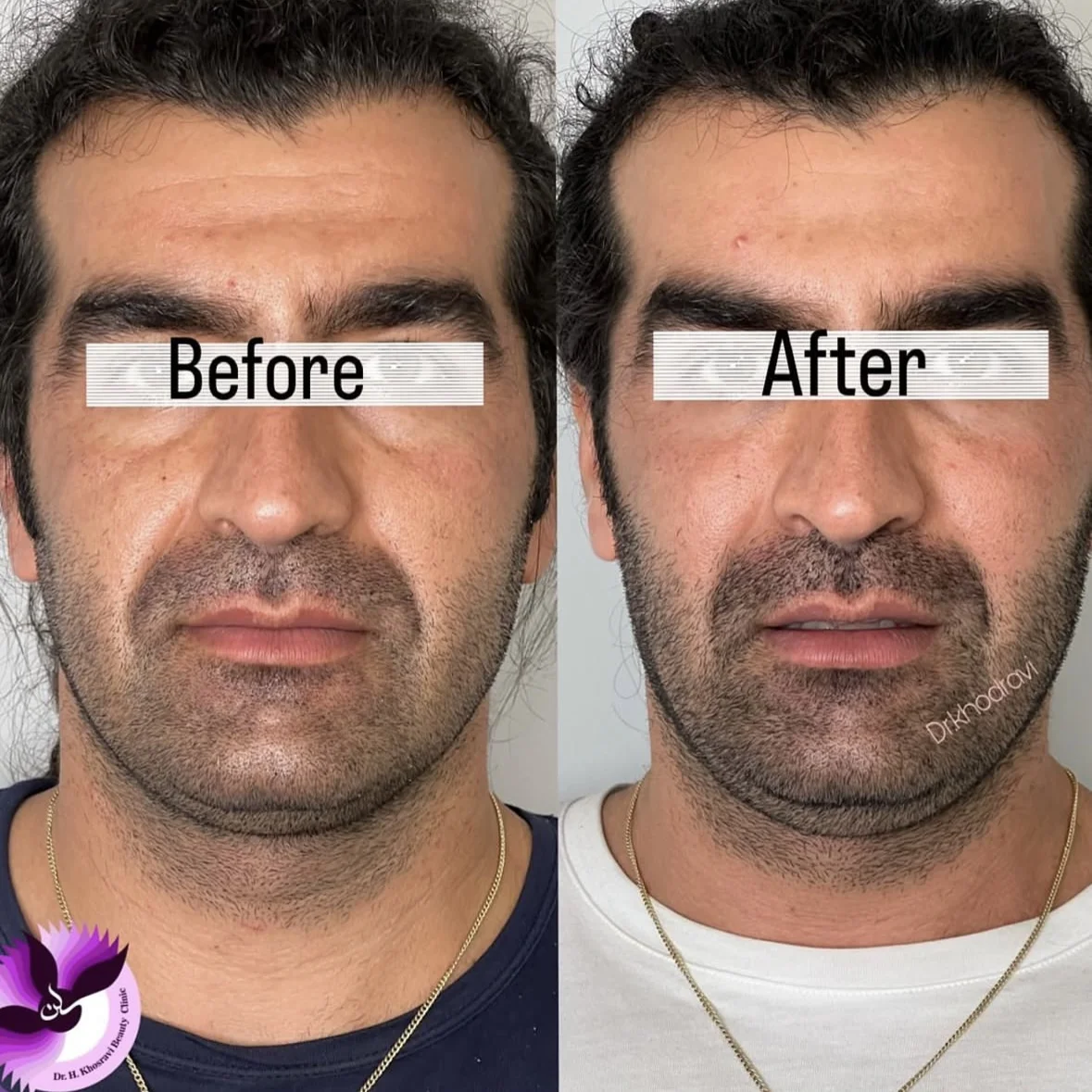 بوتاکس در کلینیک دکتر خسروی