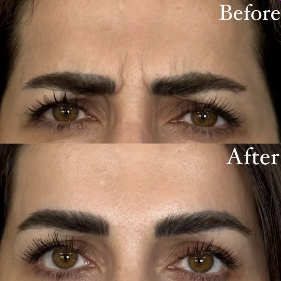 بوتاکس ابرو در ساری